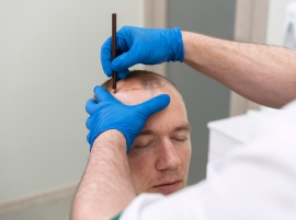 Hair Transplant Surgery