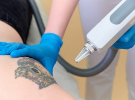 Laser-Based Tattoo Removal